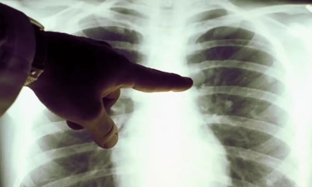 cáncer de pulmón paa fumadores