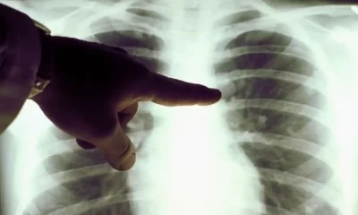 cáncer de pulmón paa fumadores